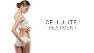 Cellulite removal for smoother skin