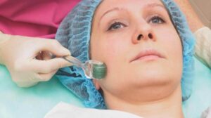 Skin revitalizing with microneedling treatment