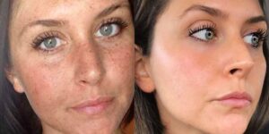Sun damage and brown spot removal